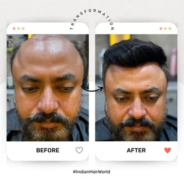After Hair Transplant